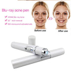 Blue Light Acne Treatment Pen – Targeted Skin Care Device - GluxeHaus