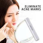 Blue Light Acne Treatment Pen – Targeted Skin Care Device - GluxeHaus