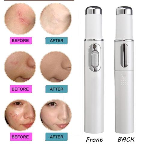 Blue Light Acne Treatment Pen – Targeted Skin Care Device - GluxeHaus